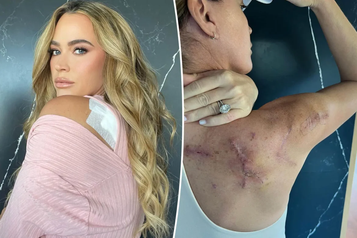 Teddi Mellencamp’s Journey Through Stage 4 Melanoma Teddi Mellencamp’s Journey Through Stage 4 Melanoma: Resilience Amid Challenges